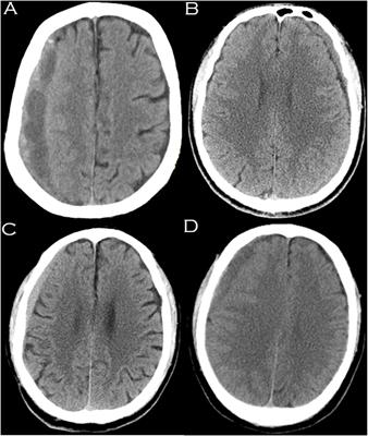 Risk Factors for Atorvastatin as a Monotherapy for Chronic Subdural Hematoma: A Retrospective Multifactor Analysis